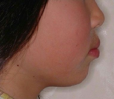 治療前