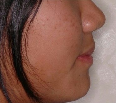 治療後